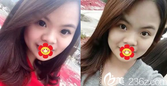 做假體隆鼻手術(shù)前的塌鼻子 做假體隆鼻手術(shù)前的塌鼻子