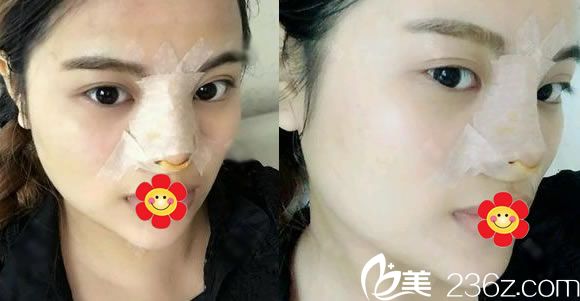 在金華光大做完硅膠隆鼻當(dāng)天效果 在金華光大做完硅膠隆鼻當(dāng)天效果