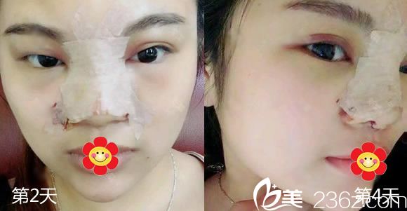 做完假體隆鼻第2天和第4天 做完假體隆鼻第2天和第4天