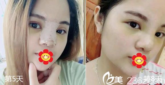 硅膠隆鼻手術(shù)后5天和8天恢復(fù)照 硅膠隆鼻手術(shù)后5天和8天恢復(fù)照