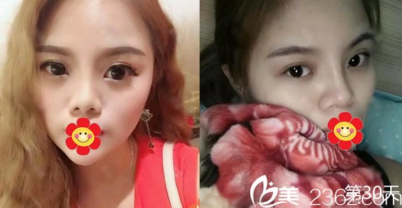 金華光大蔣建光隆鼻案例30天效果 金華光大蔣建光隆鼻案例30天效果