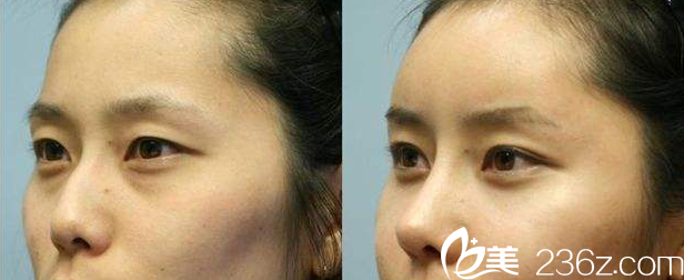 運城華美<!--<i data=20240703-sp></i>-->隆鼻失敗修復案例對比圖 運城華美<!--<i data=20240703-sp></i>-->隆鼻失敗修復案例對比圖
