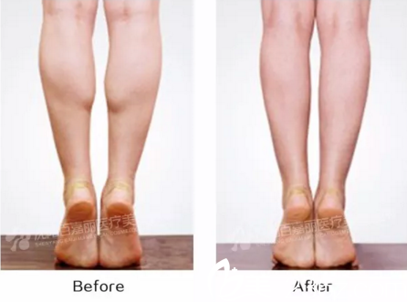 百嘉麗瘦腿注射效果