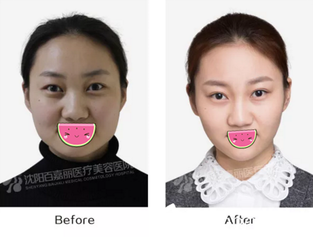 百嘉麗瘦臉效果