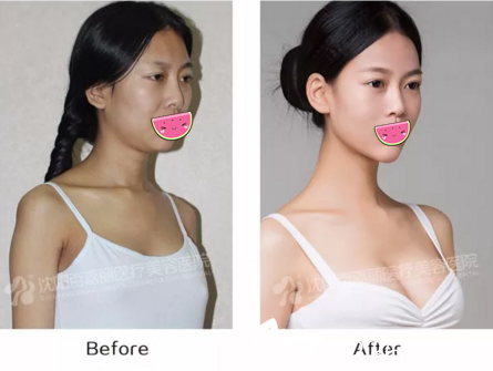 假體豐胸效果對(duì)比