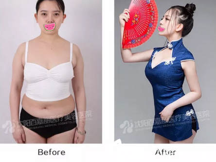 百嘉麗溶脂術(shù)效果對(duì)比