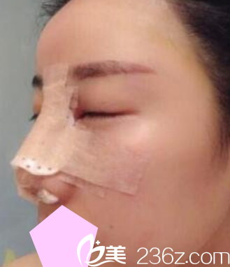 運城華美<!--<i data=20240703-sp></i>-->隆鼻失敗修復(fù)手術(shù)后第3天照片