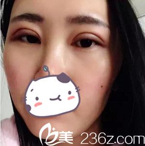 沈陽名流做雙眼皮術(shù)后第2天