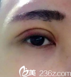 沈陽名流做雙眼皮術(shù)后第3天