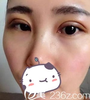 沈陽名流做雙眼皮術(shù)后第4天