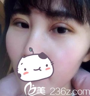 沈陽名流做雙眼皮術(shù)后第5天