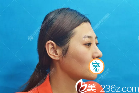 術(shù)前側(cè)面照 術(shù)前側(cè)面照