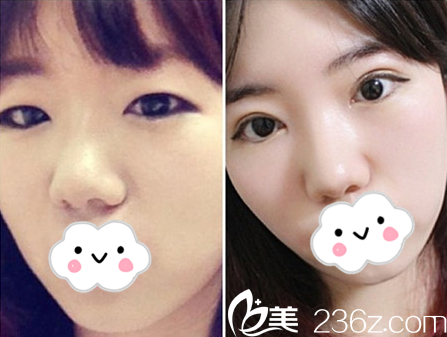 雙眼皮真人案例