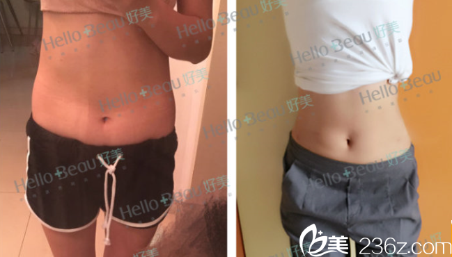 羅<!--<i data=20240703-sp></i>-->醫(yī)生腰腹部吸脂案例 羅<!--<i data=20240703-sp></i>-->醫(yī)生腰腹部吸脂案例