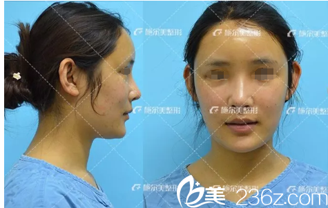 自體脂肪填充術后天恢復 自體脂肪填充術后天恢復