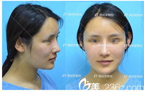 術后第五天自體脂肪恢復 術后第五天自體脂肪恢復