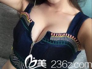 自體脂肪隆胸手術(shù)后20天效果 自體脂肪隆胸手術(shù)后20天效果