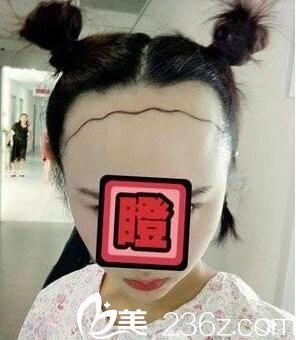 手術(shù)前設(shè)計(jì) 手術(shù)前設(shè)計(jì)