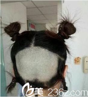 術(shù)前取發(fā) 術(shù)前取發(fā)