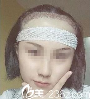 術(shù)后即刻效果 術(shù)后即刻效果