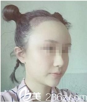 種植后三天效果 種植后三天效果