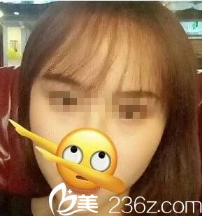 大腦門有救了！只需像她一樣去類似于武漢天申這樣的醫(yī)院做個發(fā)際線移植