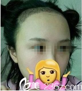 種植后一周效果 種植后一周效果