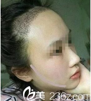 種植后一周效果 種植后一周效果