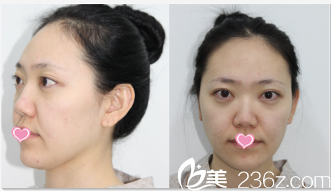 韓國德嘉整形外科醫(yī)院案例術(shù)前照 韓國德嘉整形外科醫(yī)院案例術(shù)前照