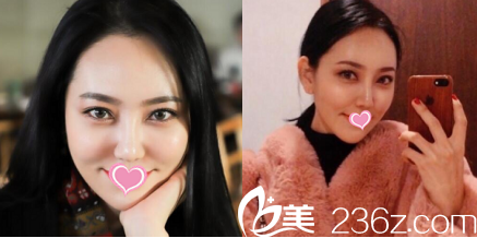 韓國德嘉整形外科醫(yī)院案例術(shù)后28天效果 韓國德嘉整形外科醫(yī)院案例術(shù)后28天效果