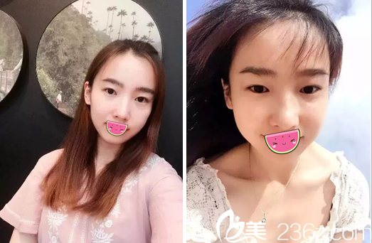 成都藝星詳解激光祛斑治療過程分享術(shù)后效果 展示正規(guī)醫(yī)美機(jī)構(gòu)祛斑實(shí)力