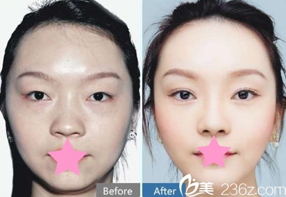 趙貴慶醫(yī)生隆鼻+雙眼皮+開眼角真人案例效果圖片