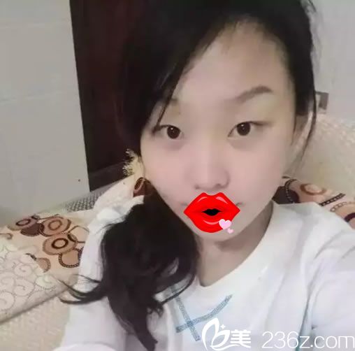 在紹興維美做眼鼻整形手術(shù)前 在紹興維美做眼鼻整形手術(shù)前