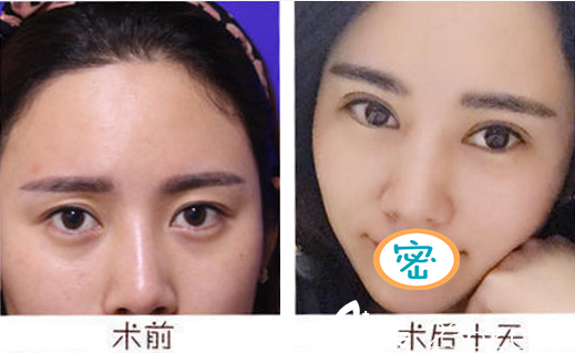 成都藝星何林雙眼皮案例 成都藝星何林雙眼皮案例