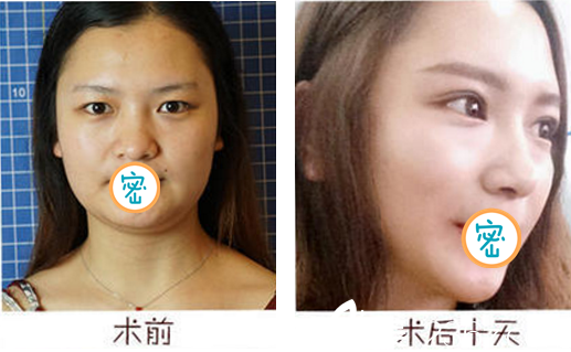 成都藝星何林雙眼皮案例對比 成都藝星何林雙眼皮案例對比