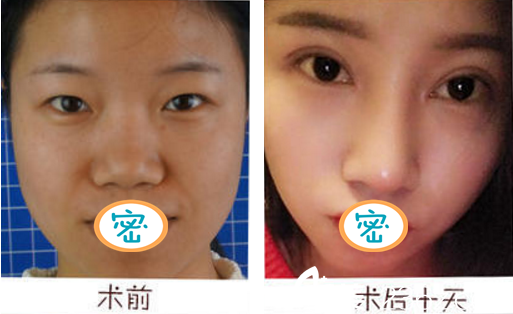 成都藝星何林雙眼皮案例術(shù)前術(shù)后對比 成都藝星何林雙眼皮案例術(shù)前術(shù)后對比