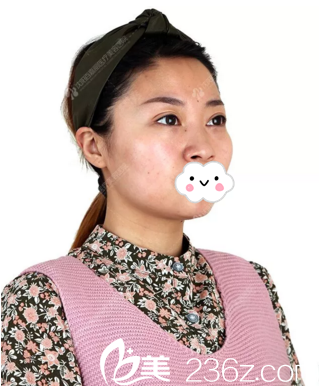 鼻綜合術(shù)前照 鼻綜合術(shù)前照