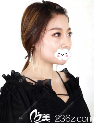 術(shù)后3個(gè)月恢復(fù)好后的鼻子 術(shù)后3個(gè)月恢復(fù)好后的鼻子