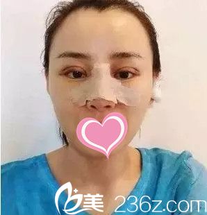 青?？等A整形醫(yī)院隆鼻手術(shù)案例