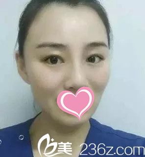 雙眼皮手術(shù)后一個(gè)月恢復(fù)效果