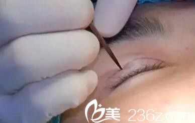 雙眼皮術(shù)前設(shè)計 雙眼皮術(shù)前設(shè)計