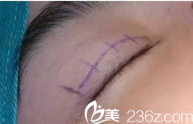 雙眼皮手術(shù)前標記 雙眼皮手術(shù)前標記