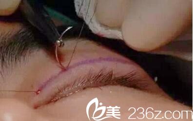 縫合雙眼皮 縫合雙眼皮