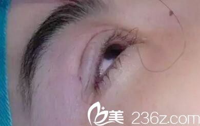 埋線雙眼皮術(shù)中 埋線雙眼皮術(shù)中