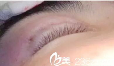 信陽埋線雙眼皮 信陽埋線雙眼皮