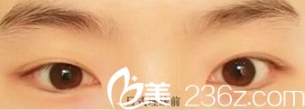 信陽金霞埋線雙眼皮術(shù)前 信陽金霞埋線雙眼皮術(shù)前