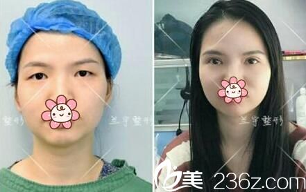 蘭宇上瞼下垂+內(nèi)眥贅皮矯正術(shù)后一個月 蘭宇上瞼下垂+內(nèi)眥贅皮矯正術(shù)后一個月