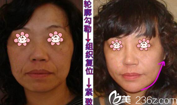 徐赤宇童顏針案例 徐赤宇童顏針案例