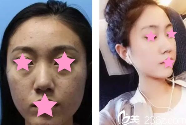 呼市京美面部脂肪填充三個月效果對比圖