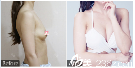 廣州曙光劉杰偉曼托假體隆胸隆胸